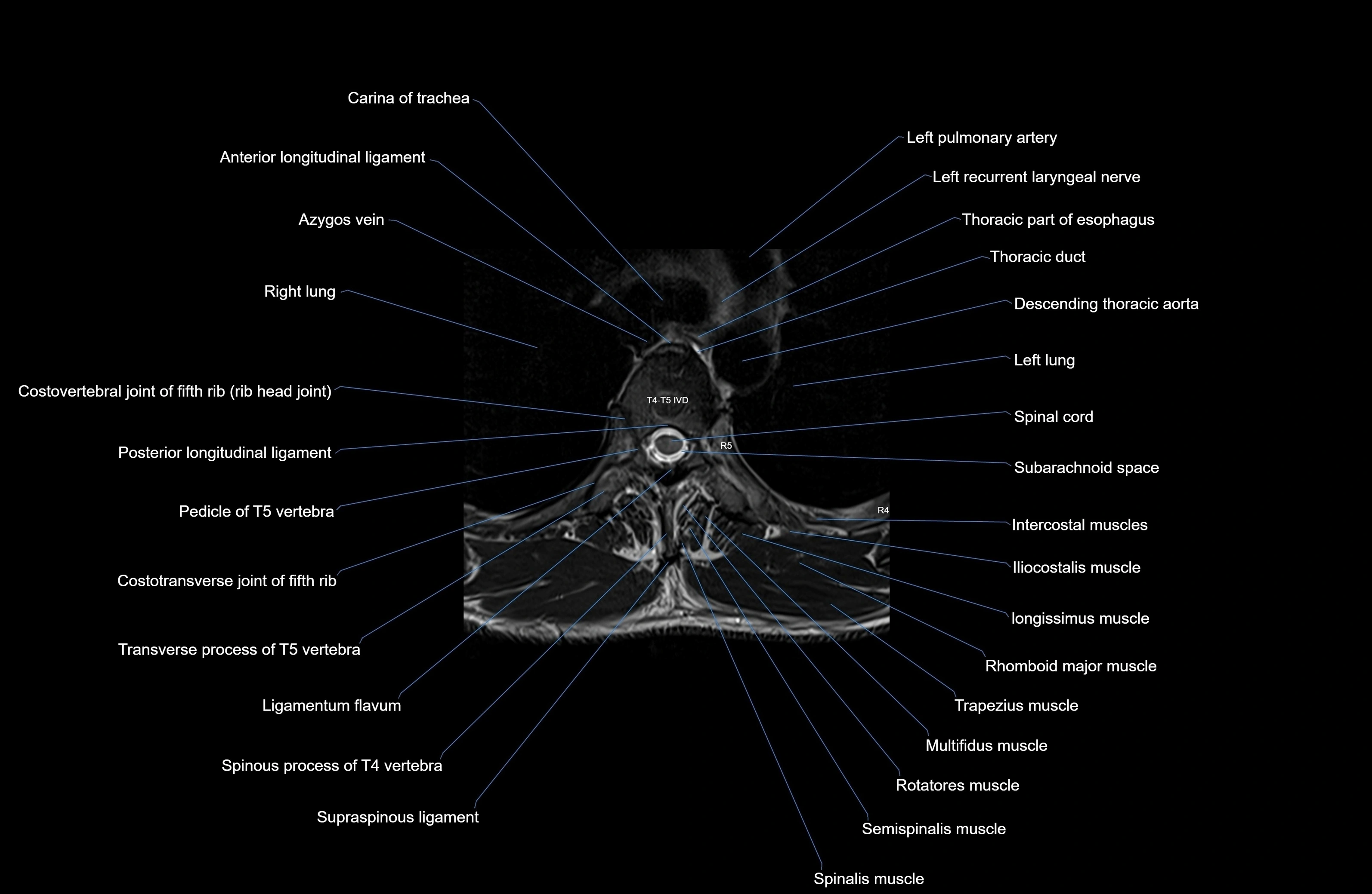 MRI thoracic spine axial  cross sectional anatomy 3T radiology  image-img-00001-00030.webp